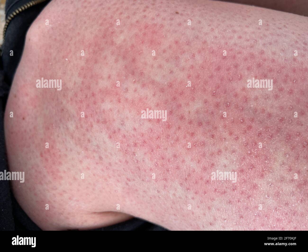 mottled skin heat rash hives allergy reaction on knee closeup