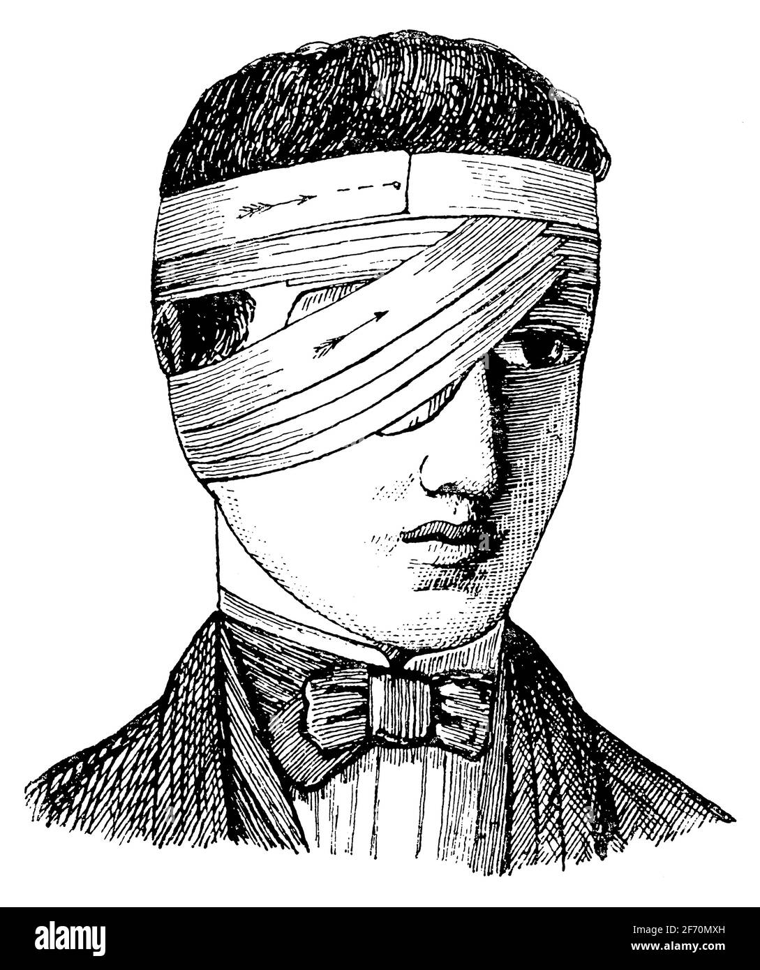 Unilateral bandage of the eye. Illustration of the 19th century. Germany. White background. Stock Photo