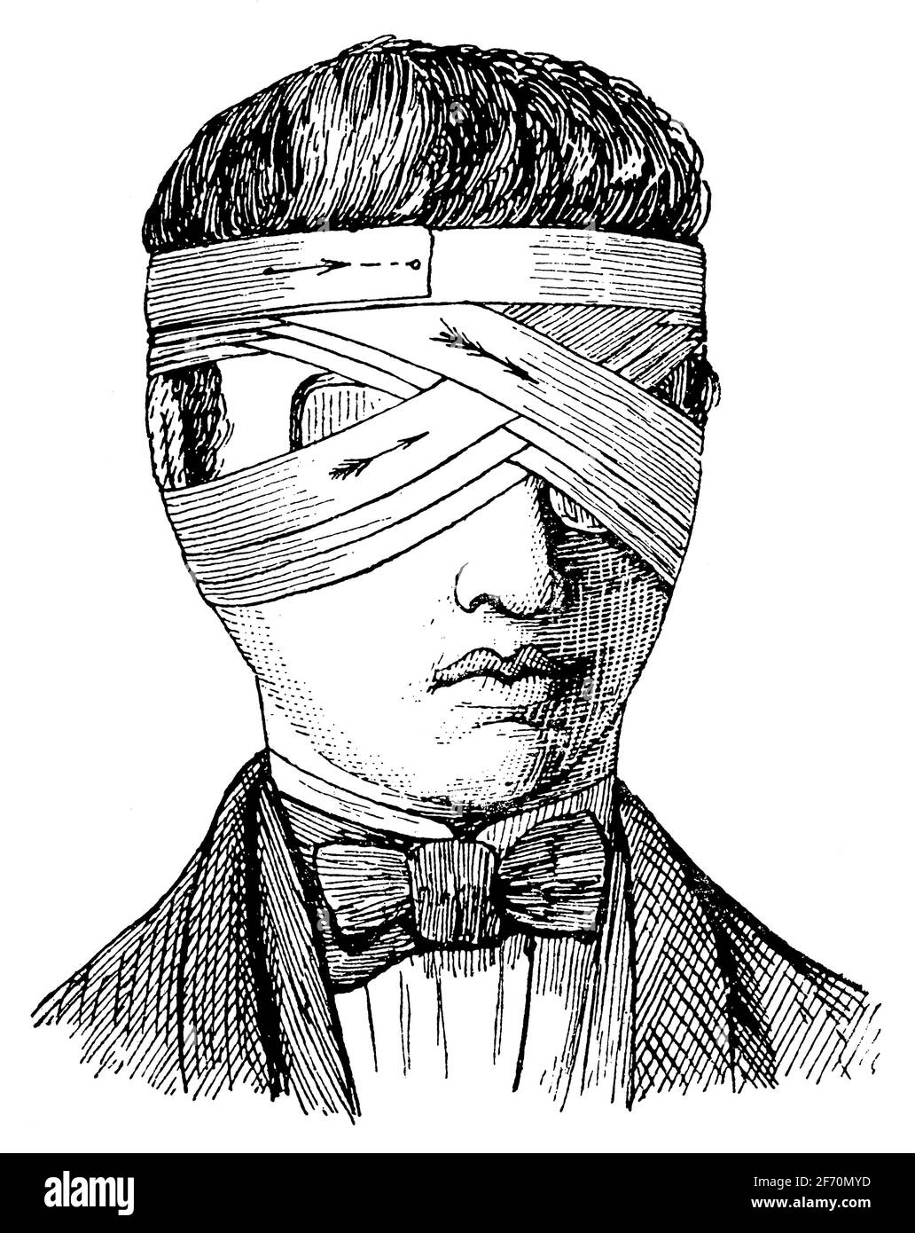 Double bandage of the eye. Illustration of the 19th century. Germany. White background. Stock Photo