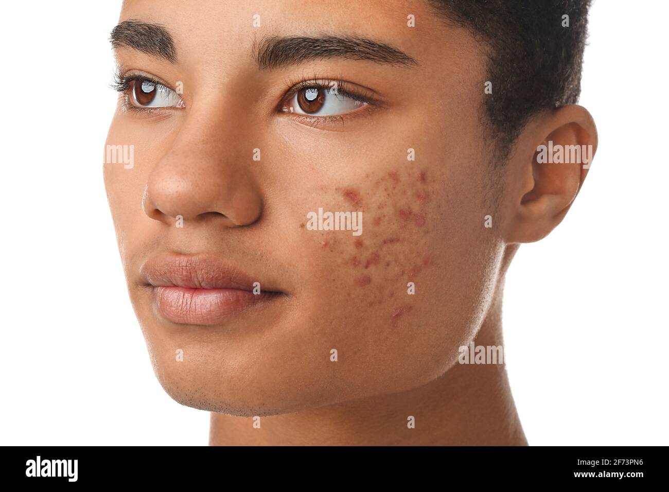 AfricanAmerican teenage boy with acne problem on white background Stock Photo Alamy