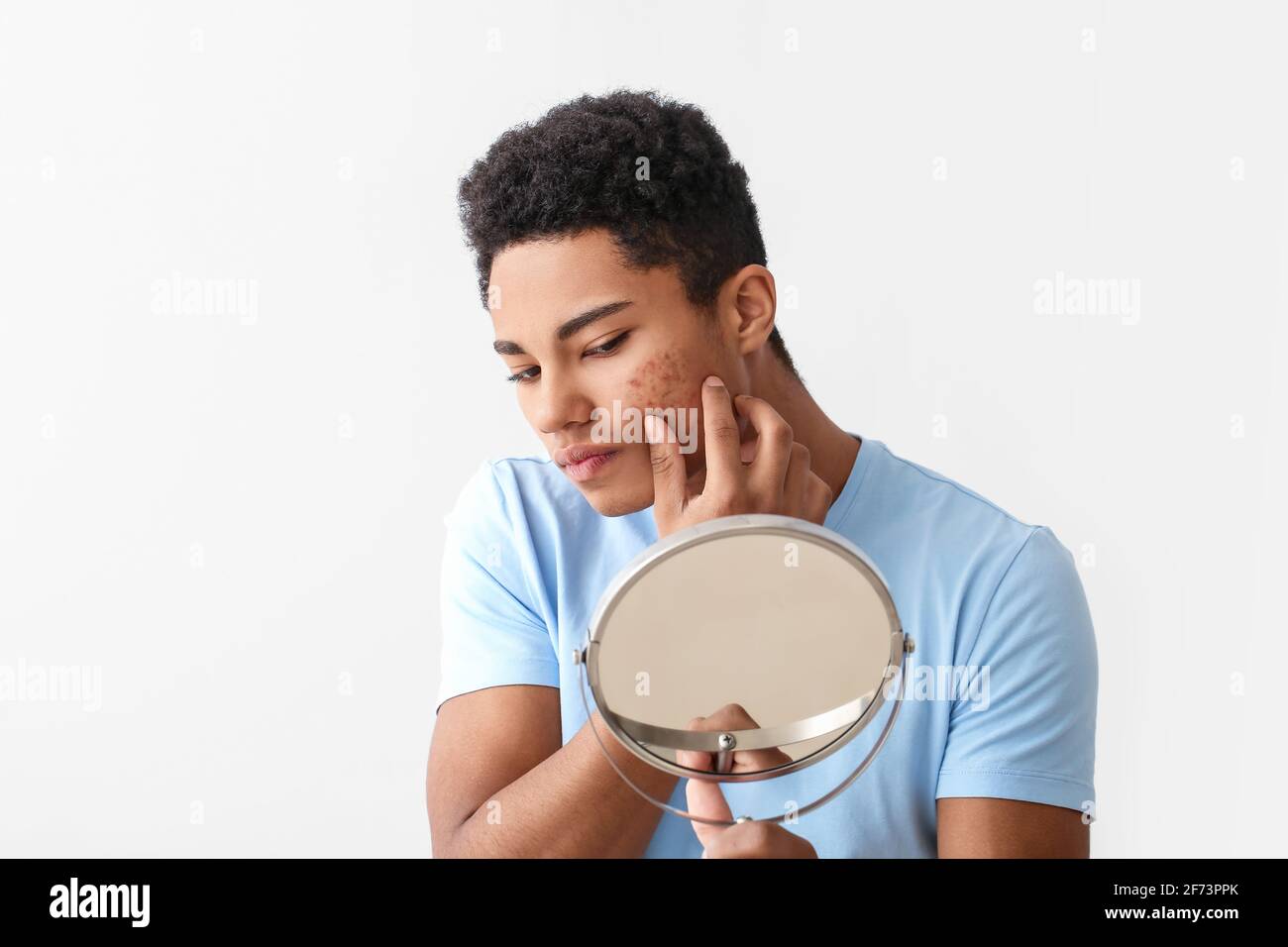 African American Teenage Boy With Acne Problem On Light Background   African American Teenage Boy With Acne Problem On Light Background 2F73PPK 