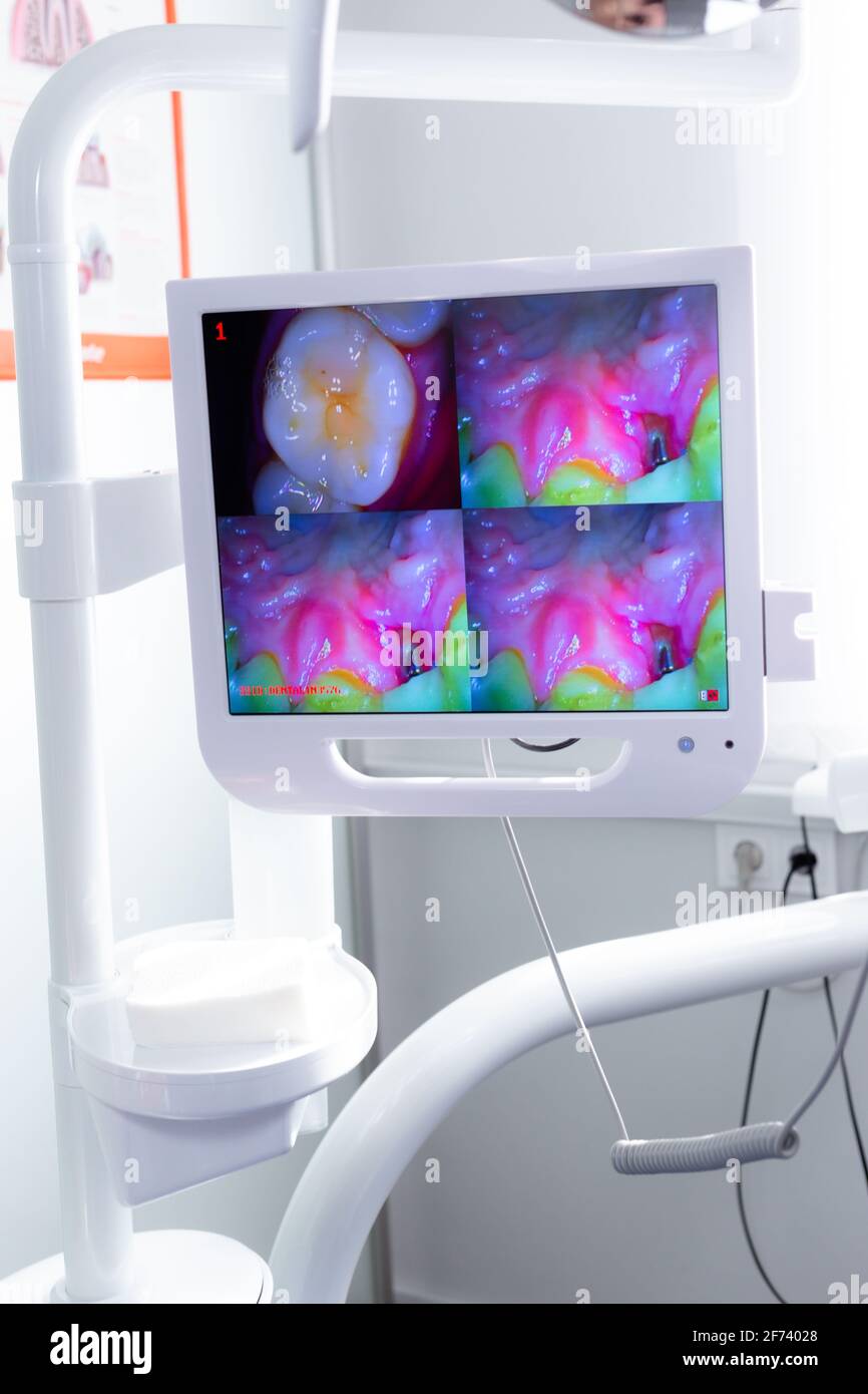Tooth Screen Screen in the dental office with a macro shot of the tooth Stock Photo ...
