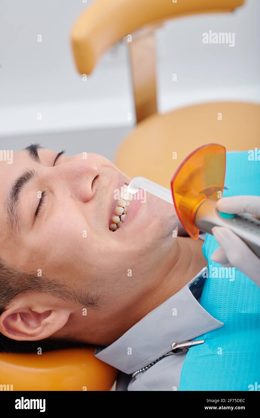 Dentist using dental curing light for polymerization of dental composite resin in teeth of young Asian man Stock Photo