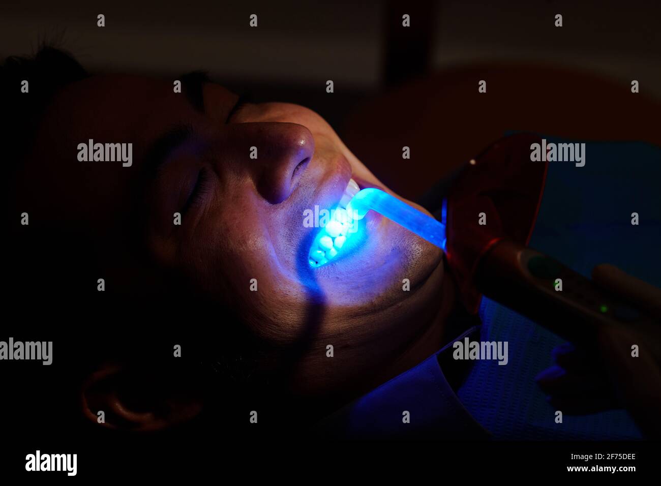 Patient with whitening agent on teeth getting procedure with ultraviolet light UV lamp Stock