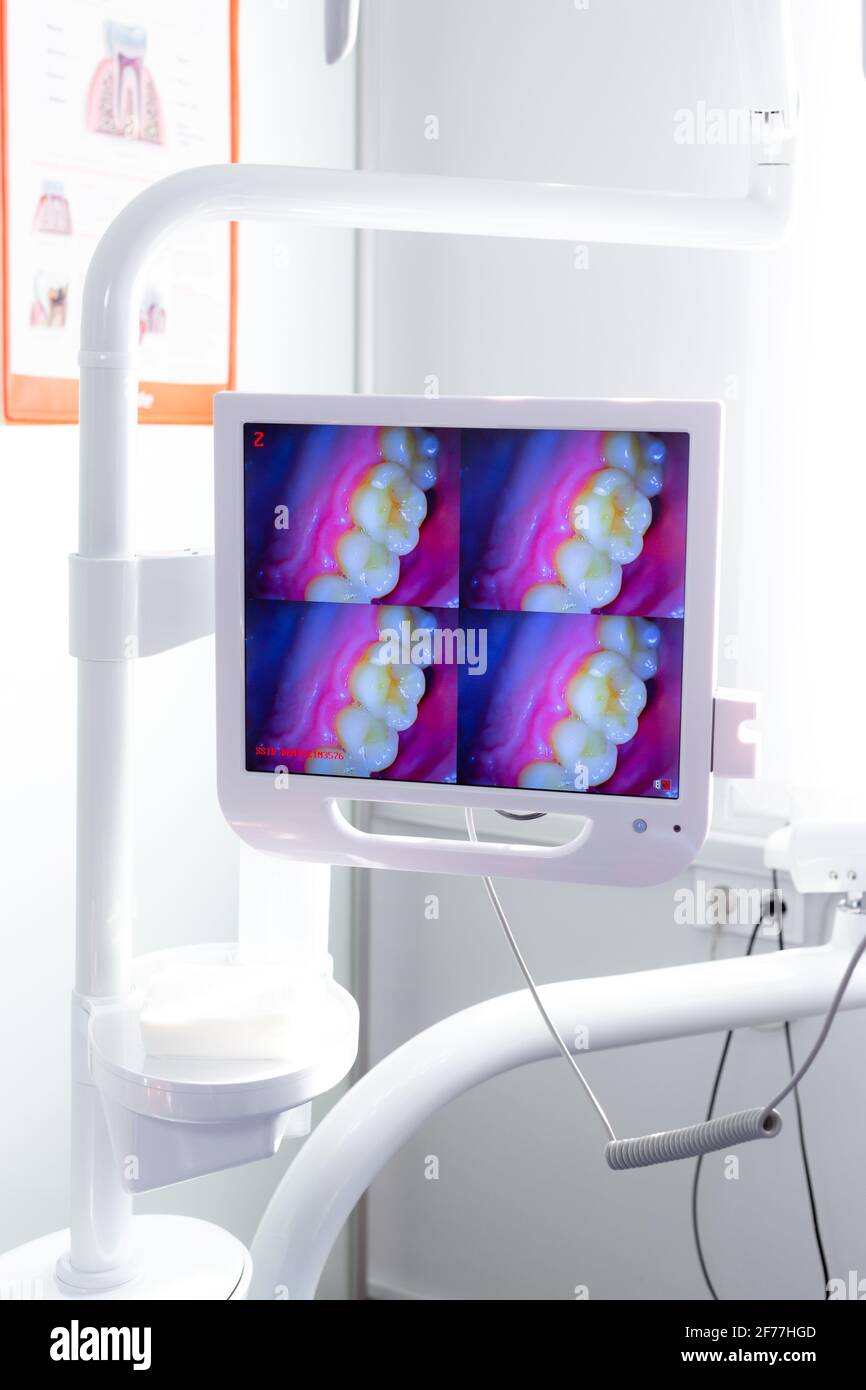 Tooth Screen Screen in the dental office with a macro shot of the tooth Stock Photo ...