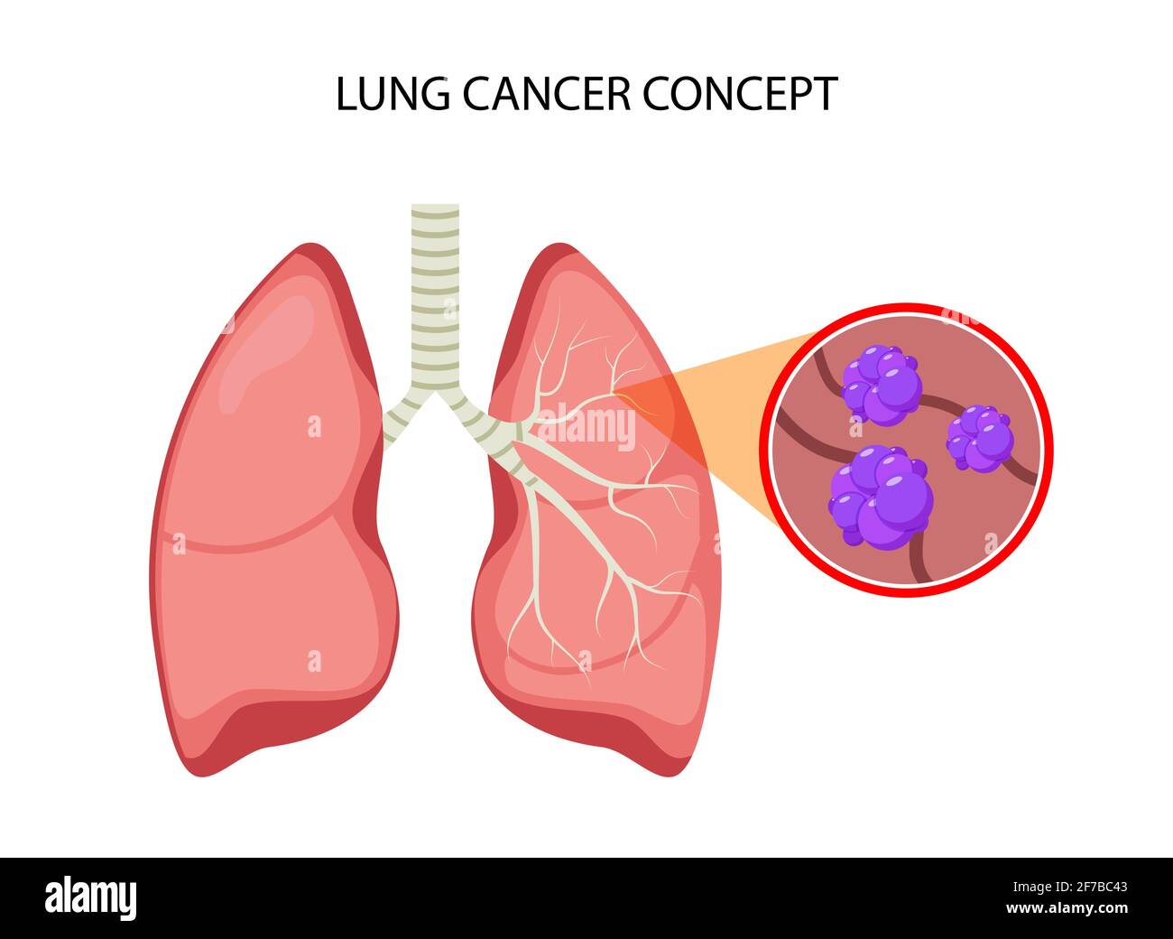 Lung cancer vector concept repiratory disease. Cartoon human lung cancer icon Stock Vector