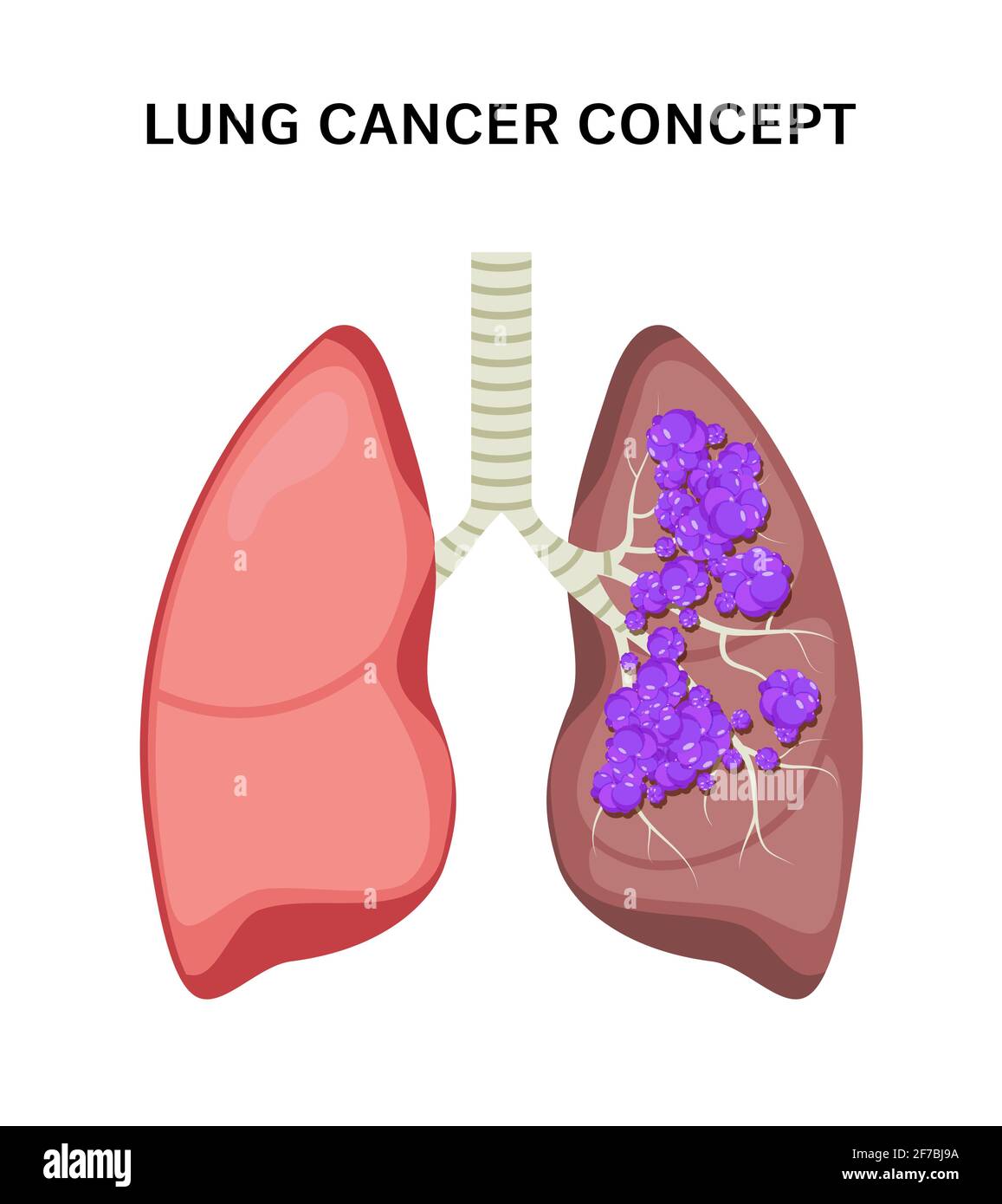 Lung cancer vector concept repiratory disease. Cartoon human lung cancer  icon Stock Vector Image & Art - Alamy