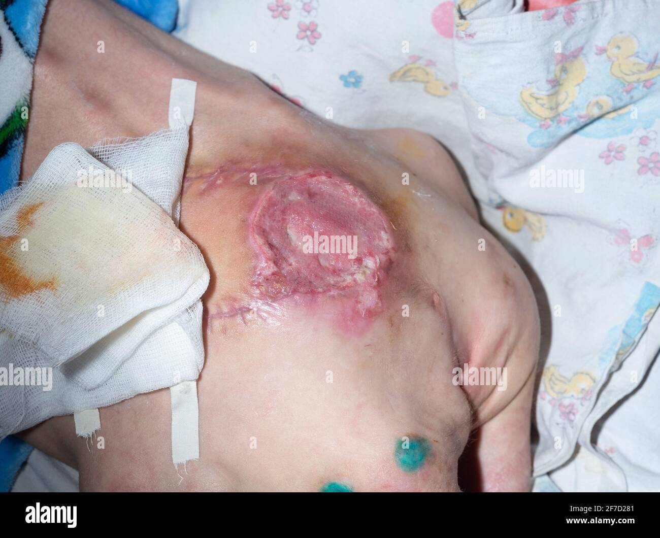 bedsores of the second degree sacrococcygeal region after surgery for plastic skin pressure sores. Stock Photo