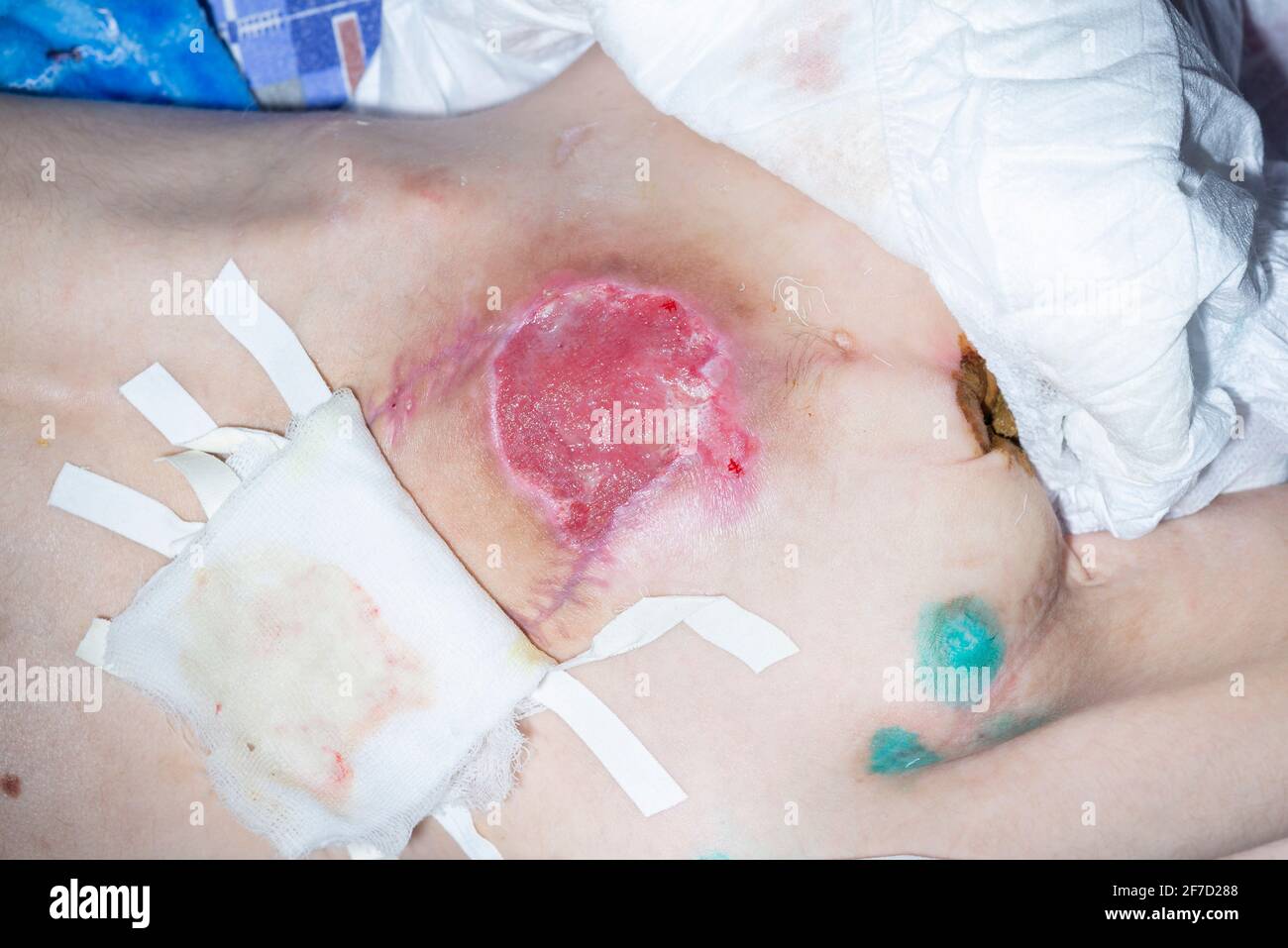 bedsores of the second degree sacrococcygeal region after surgery for plastic skin pressure sores. Stock Photo