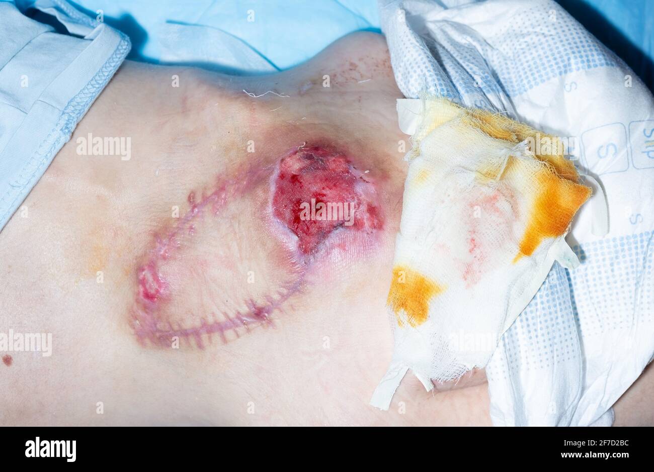bedsores of the second degree sacrococcygeal region after surgery for plastic skin pressure sores. Stock Photo