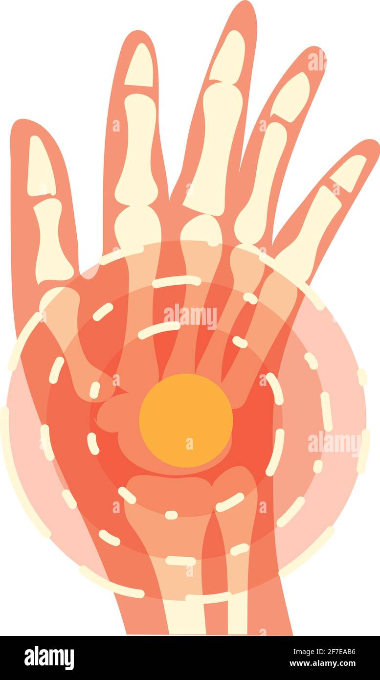 arthritis wrist pain Stock Vector Image & Art Alamy