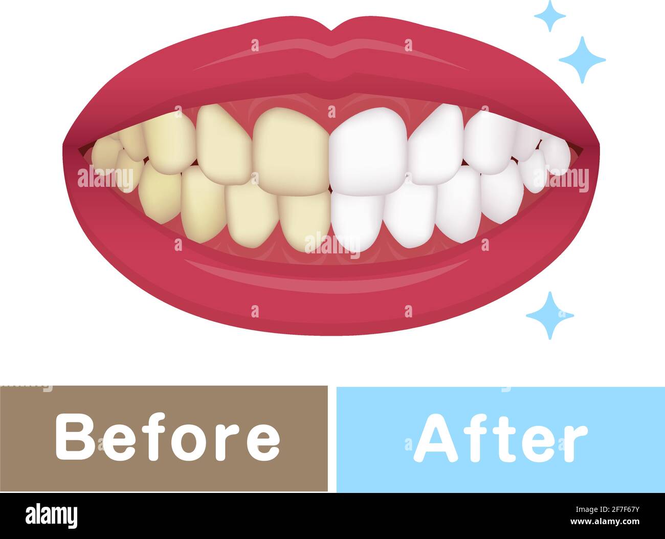 Teeth whitening vector illustration / before and after Stock Vector