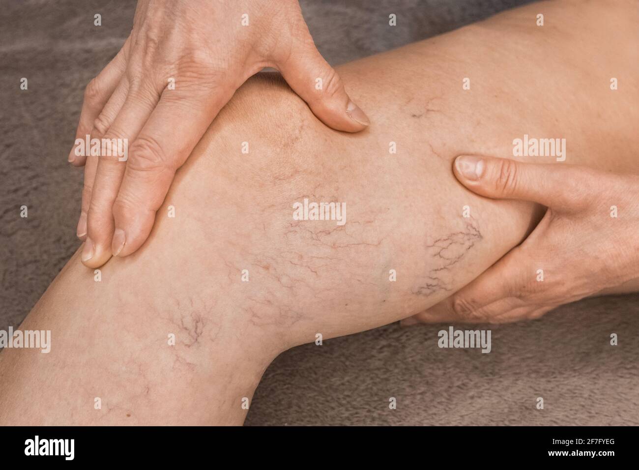 The hands of an elderly woman shows on varicose veins, sick female legs. Stock Photo
