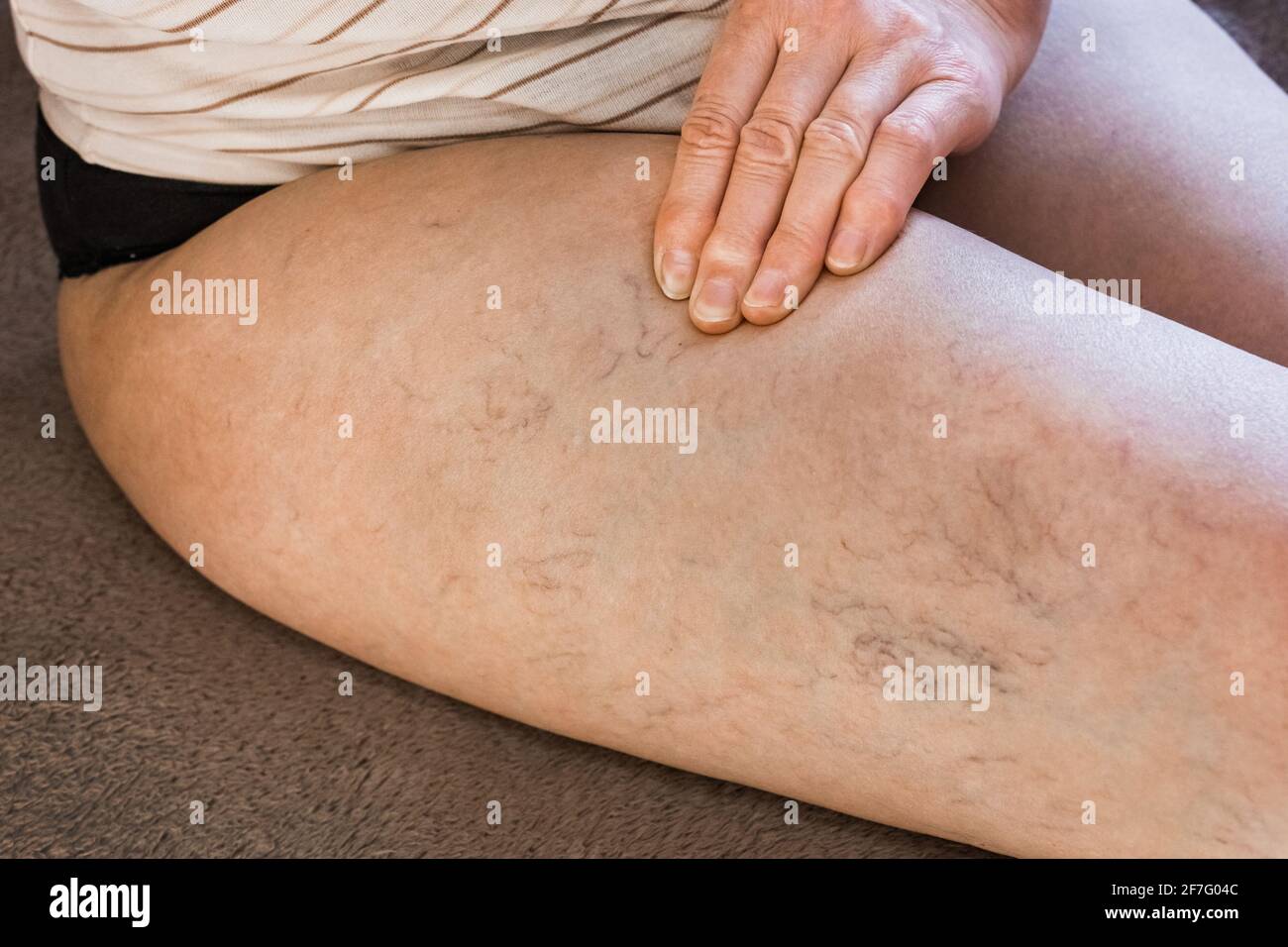 a woman puts a compression stocking on her leg with varicose veins