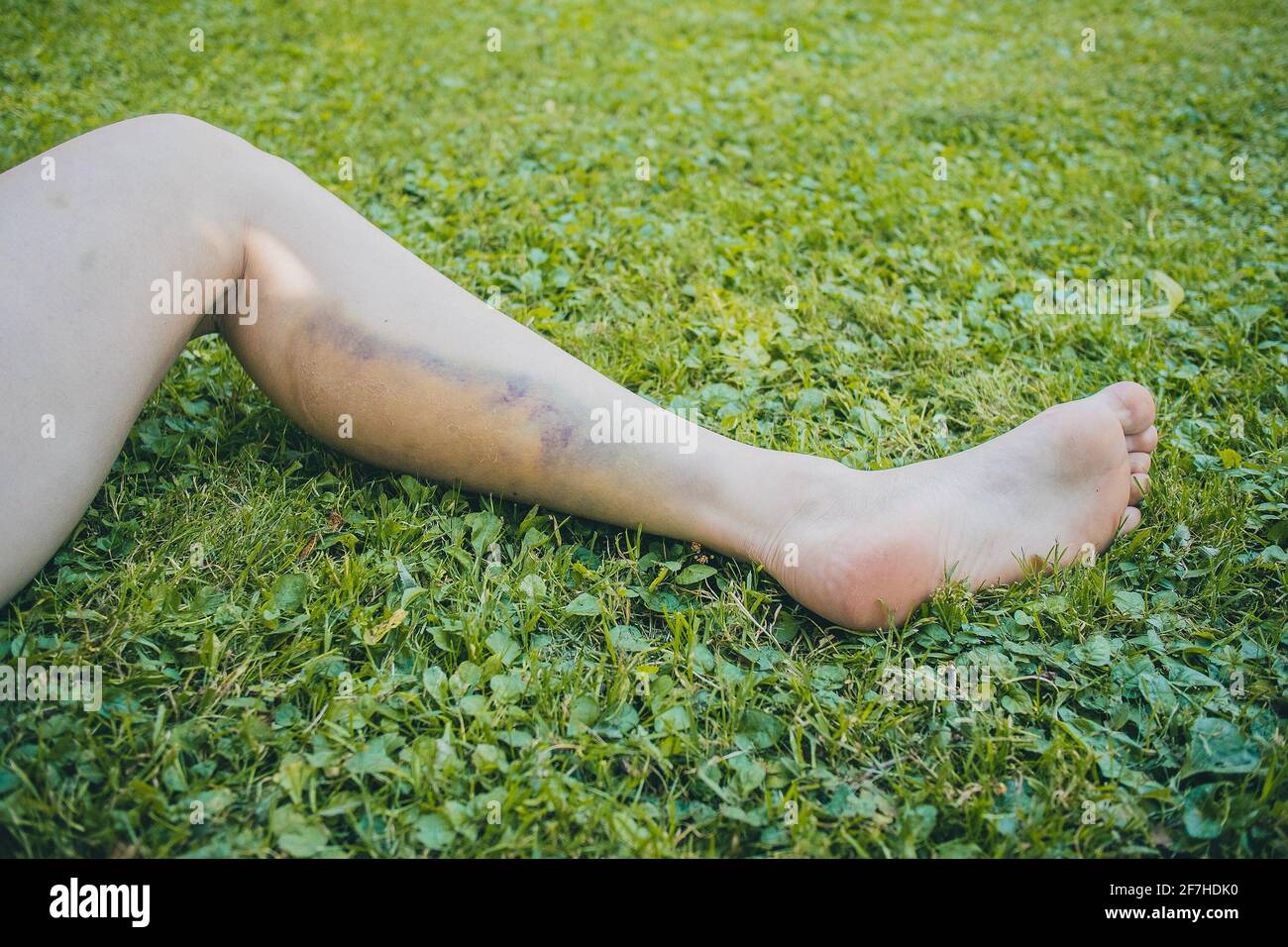 Leg of a woman with visible big blue and yellow bruise on calf muscle, due to impact or strong pressure on tissue of a leg. Picture taken outside on a Stock Photo