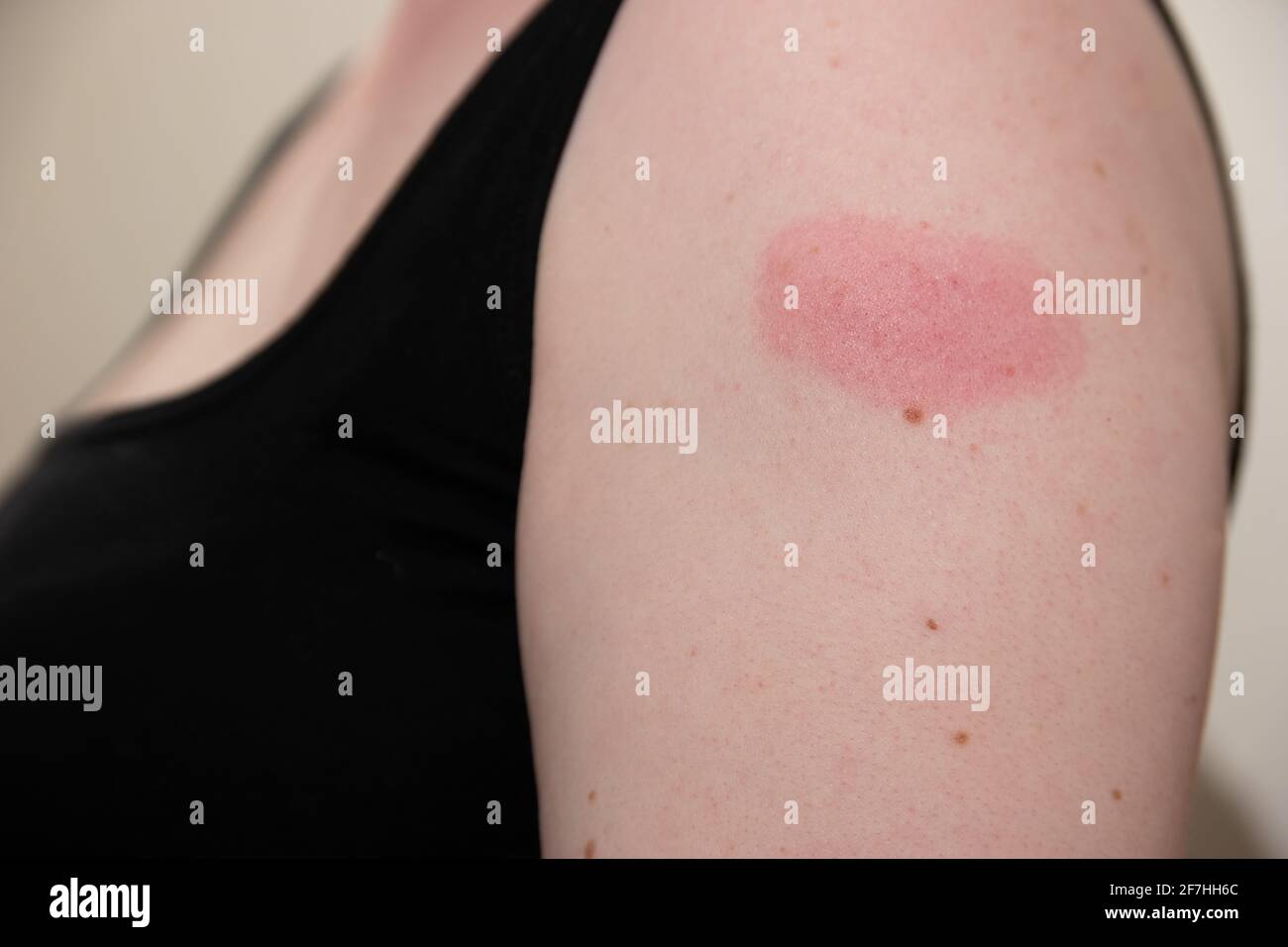 Bruise arm hires stock photography and images Alamy