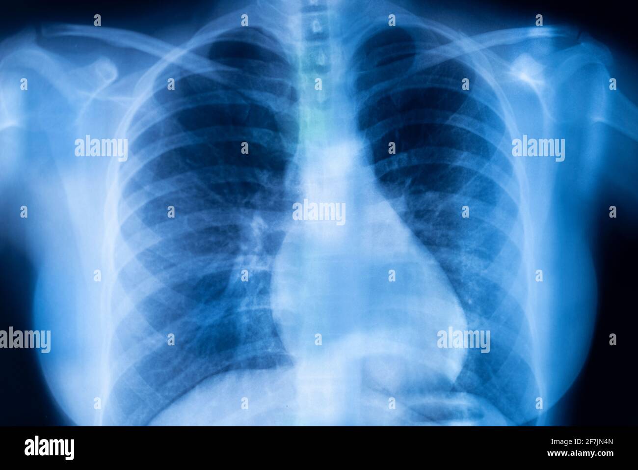 Lungs ribs xray scan test result Stock Photo Alamy