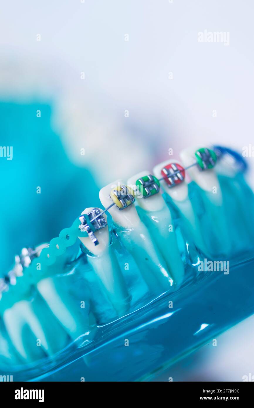 Dental teeth aligner bracket teaching student model showing gums and