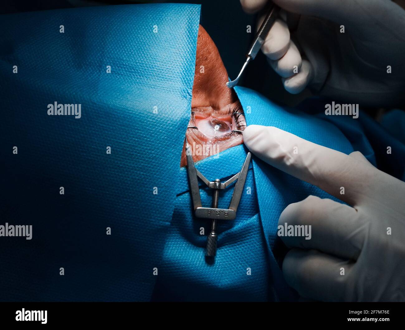 basra, Iraq - april 8, 2021:  surgeon scrubbing the corneal epithelium forPRK operation of the eye Stock Photo