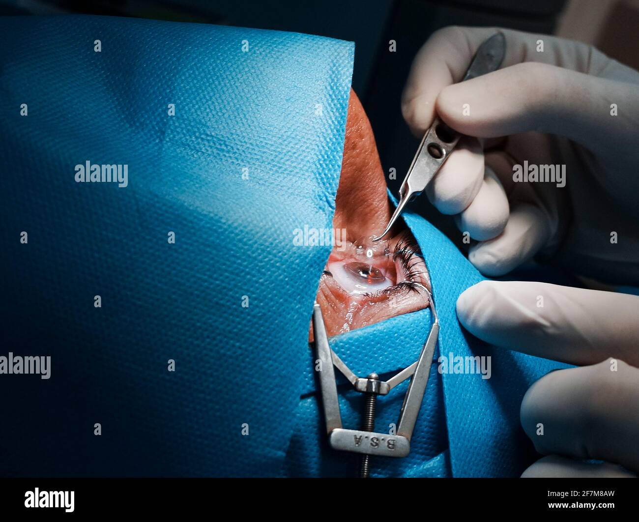Post Prk basra, Iraq - april 8, 2021: surgeon putting contact lets on the cornea ...
