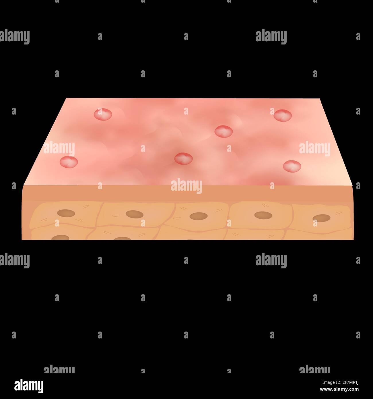 Cyst acne. Acne on the skin of a cyst. Dermatological and cosmetic ...