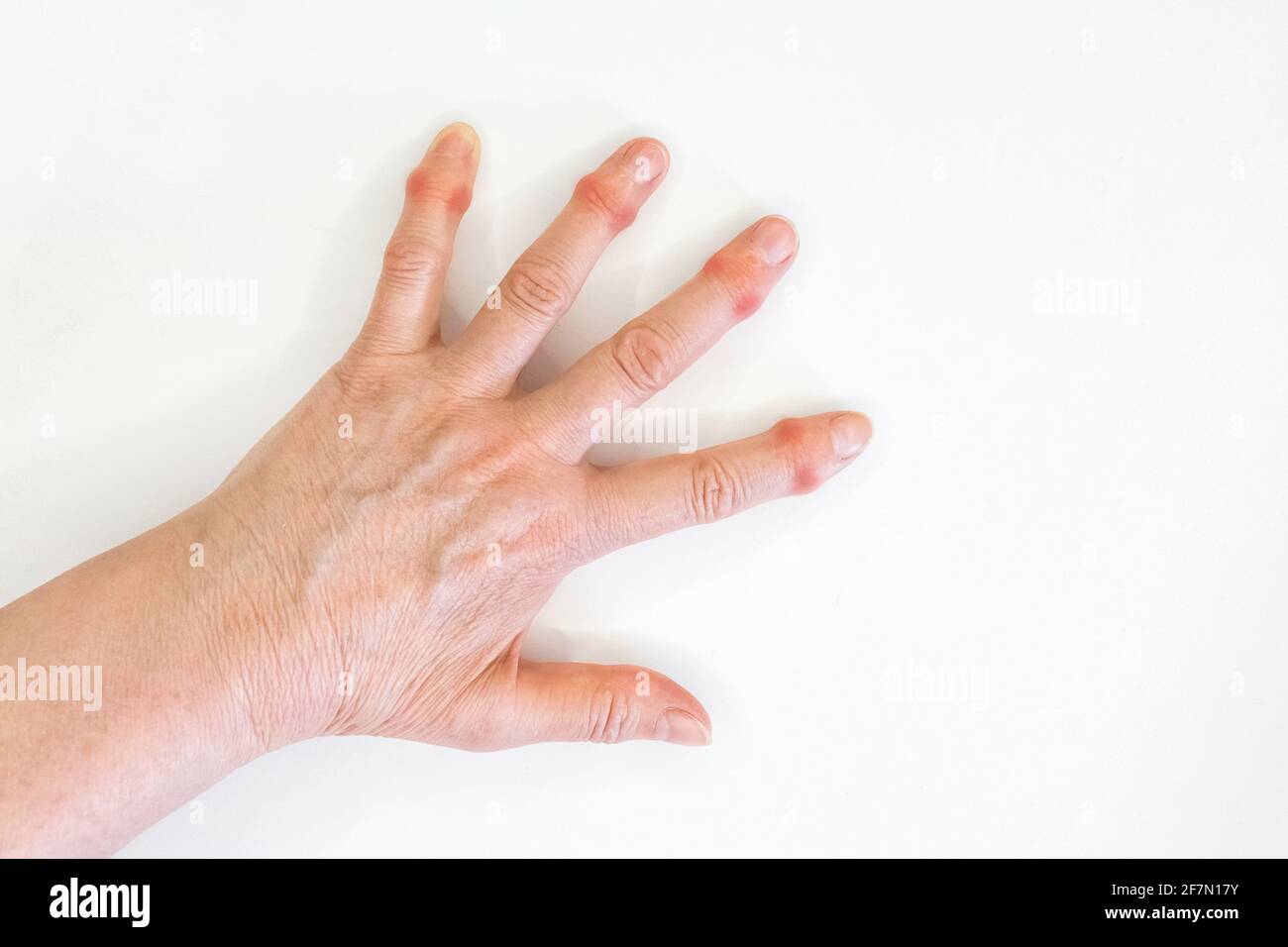 Hand of an old woman with sore fingers on a white background. Stock Photo