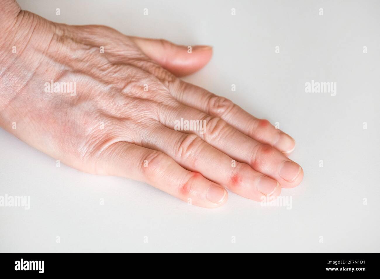 Sick female fingers of an elderly man's hand on a white background. Stock Photo