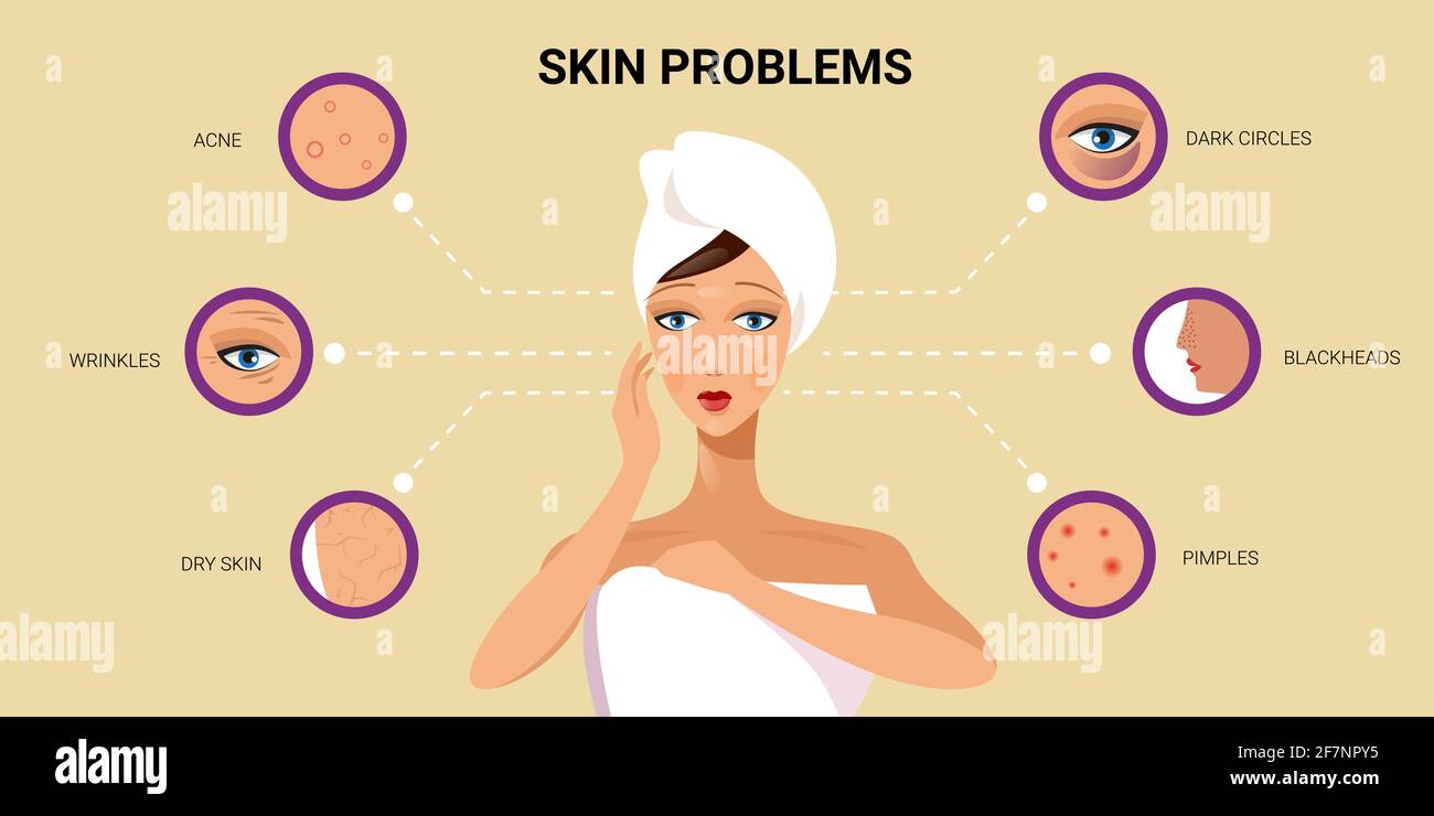 facial skin pimples acne different types on woman face pore comedones cosmetology skincare problems concept flat portrait horizontal Stock Vector