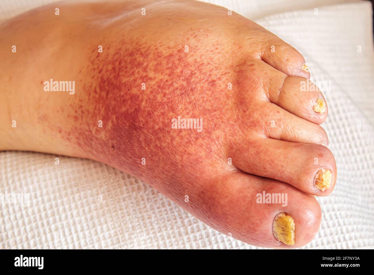 erysipelas of the legs, red rash on the legs.selectivw focus Stock Photo