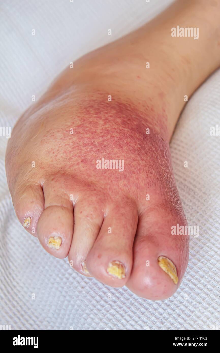 erysipelas of the legs, red rash on the legs.selectivw focus Stock Photo