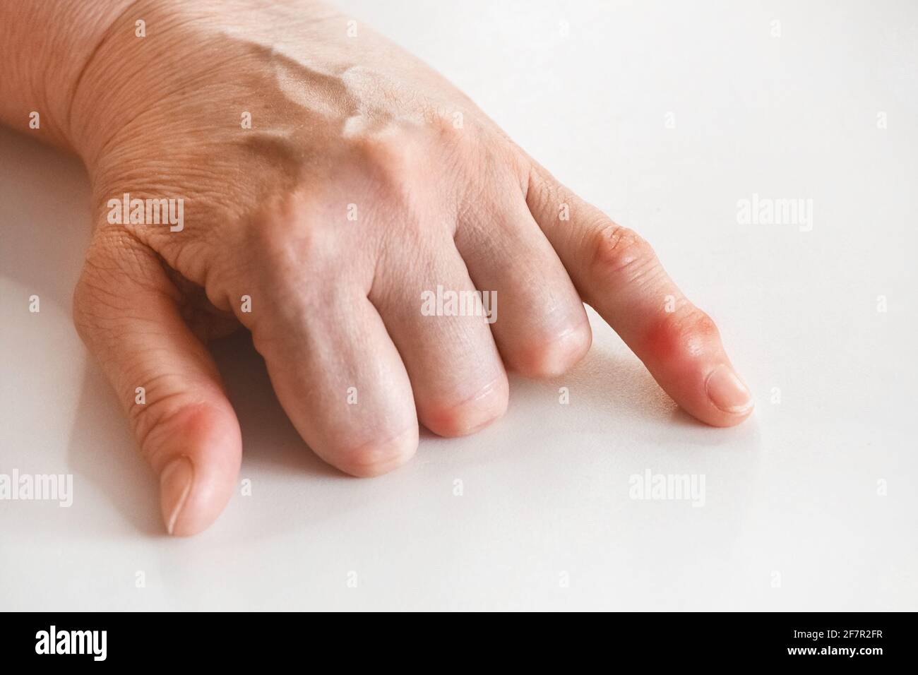 The hand of an elderly woman with hand rheumatism and a change in joints close-up. Stock Photo