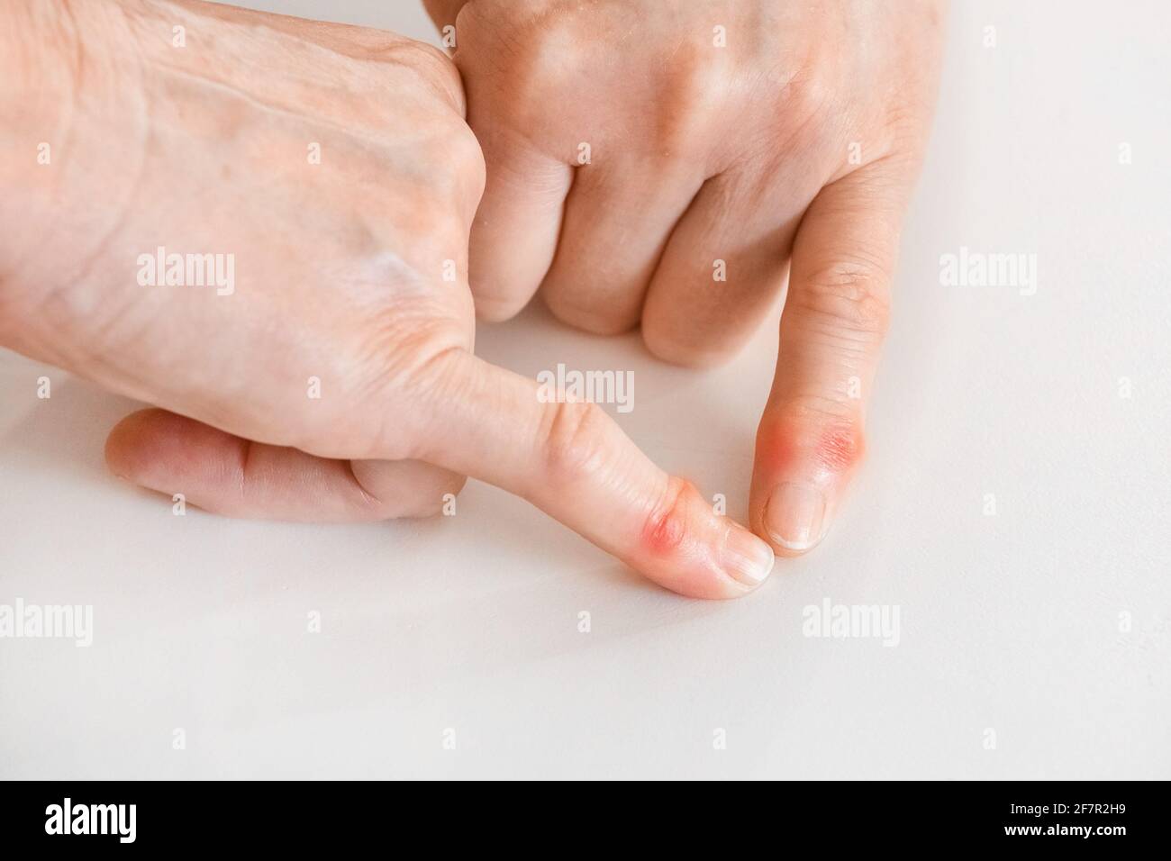 Two hands of an elderly woman indicate a disease of fingers and a change in joints close-up. Stock Photo
