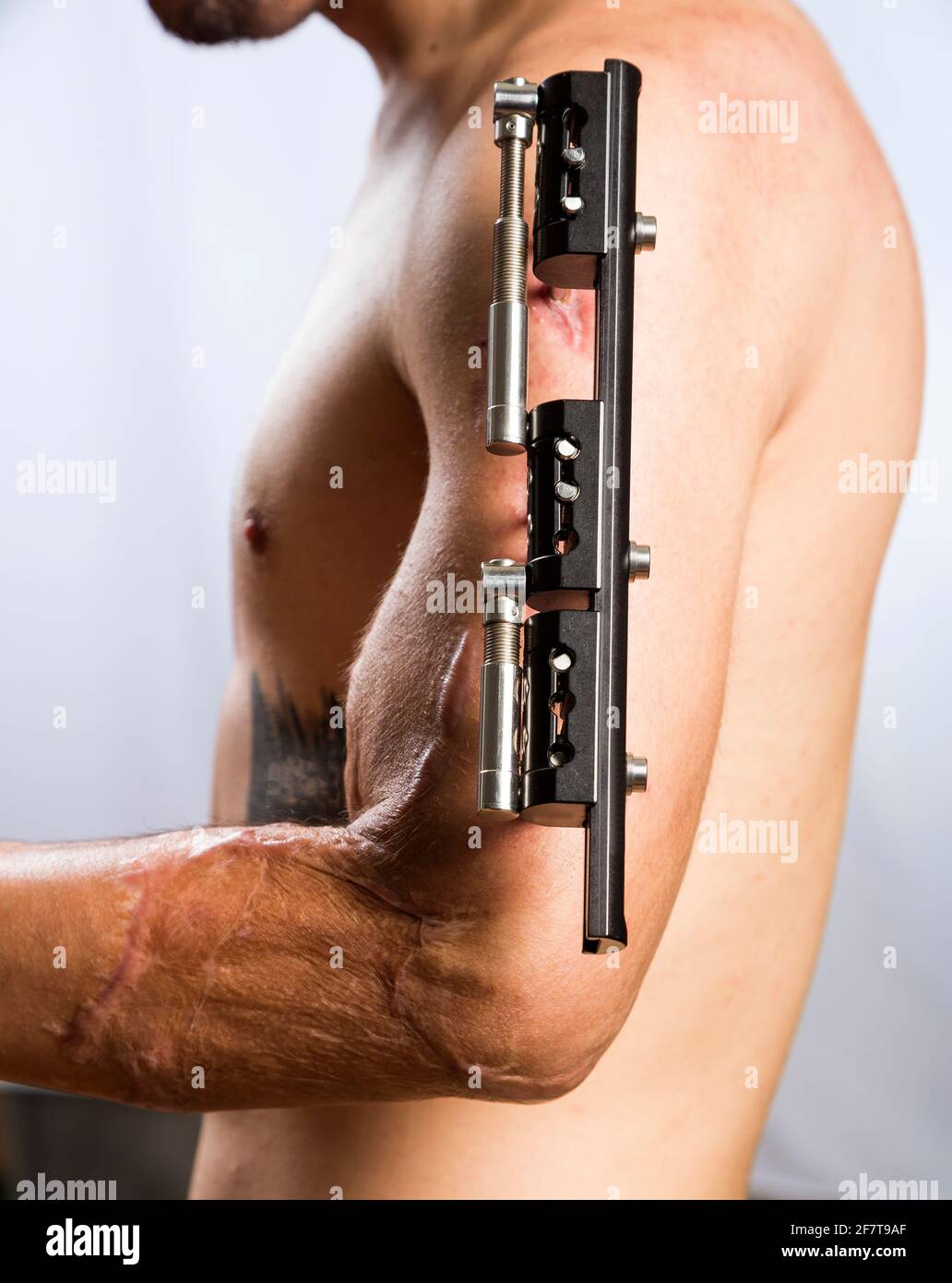 Broken arm with external metal fixator - White background Stock Photo ...