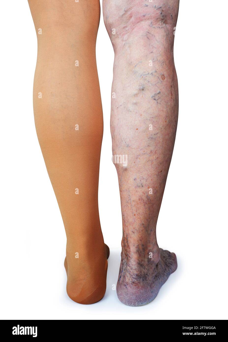 Thrombosis stockings on a leg of old woman isolated on white background. Stock Photo