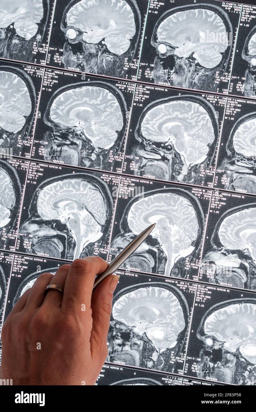 Magnetic resonance imaging, MRI, computed tomography, x-ray image. Head with brain in lateral cross-section Stock Photo