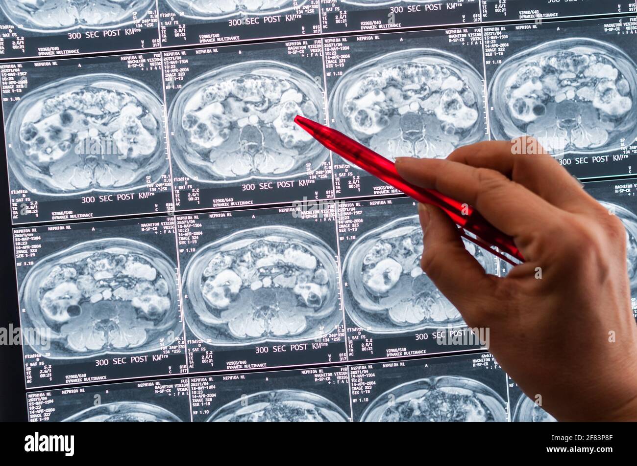 Magnetic resonance imaging, MRI, computed tomography, x-ray image.  Abdominal area in cross section Area of ​​the pelvis with kidneys infected  with tum Stock Photo - Alamy