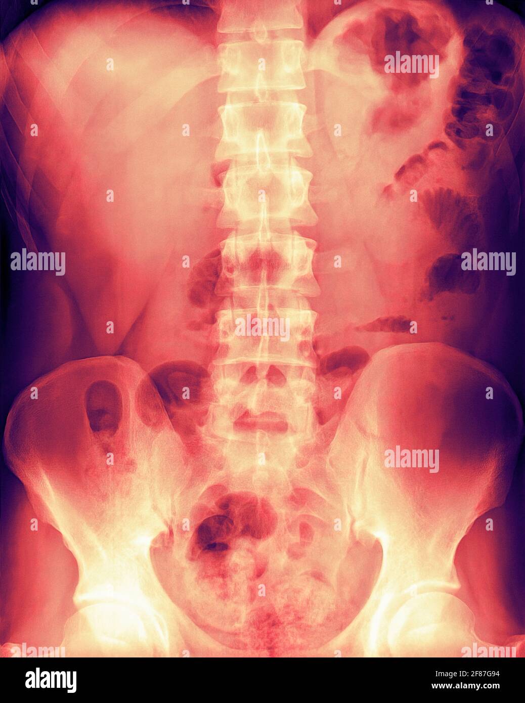 X-Ray / Xray of a human torso in colour showing Pelvis, Spine and Ribcage Stock Photo