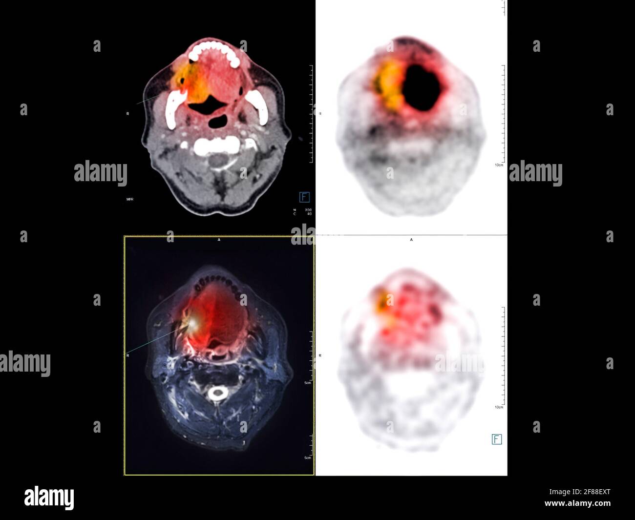 PET CT image of the Neck showing CA nasopharynx or carcinoma of ...