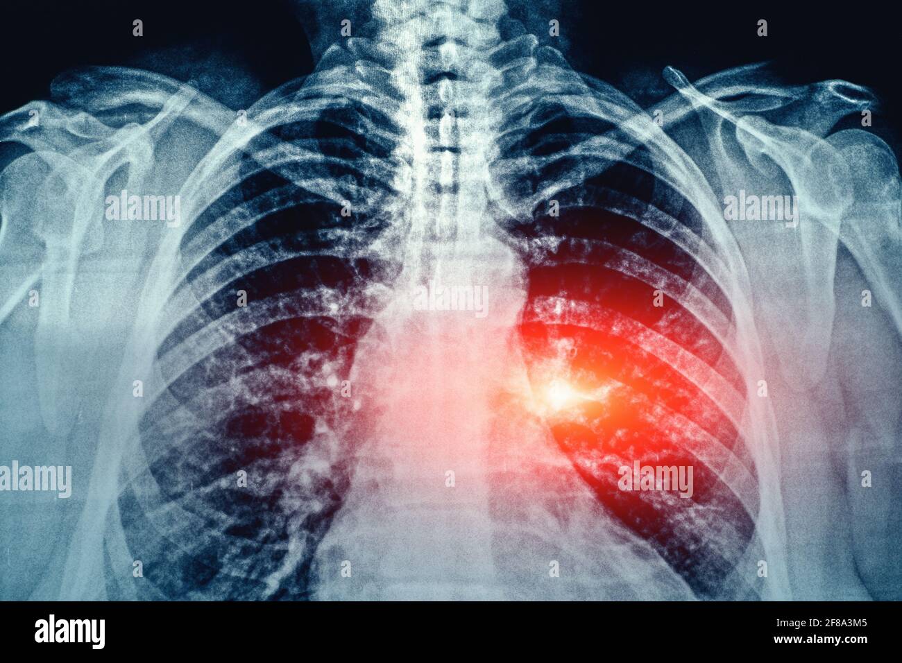 X-Ray film with grain Image of Human Chest and Lungs medical diagnosis with red area as symbol of point of pain and illness. Stock Photo