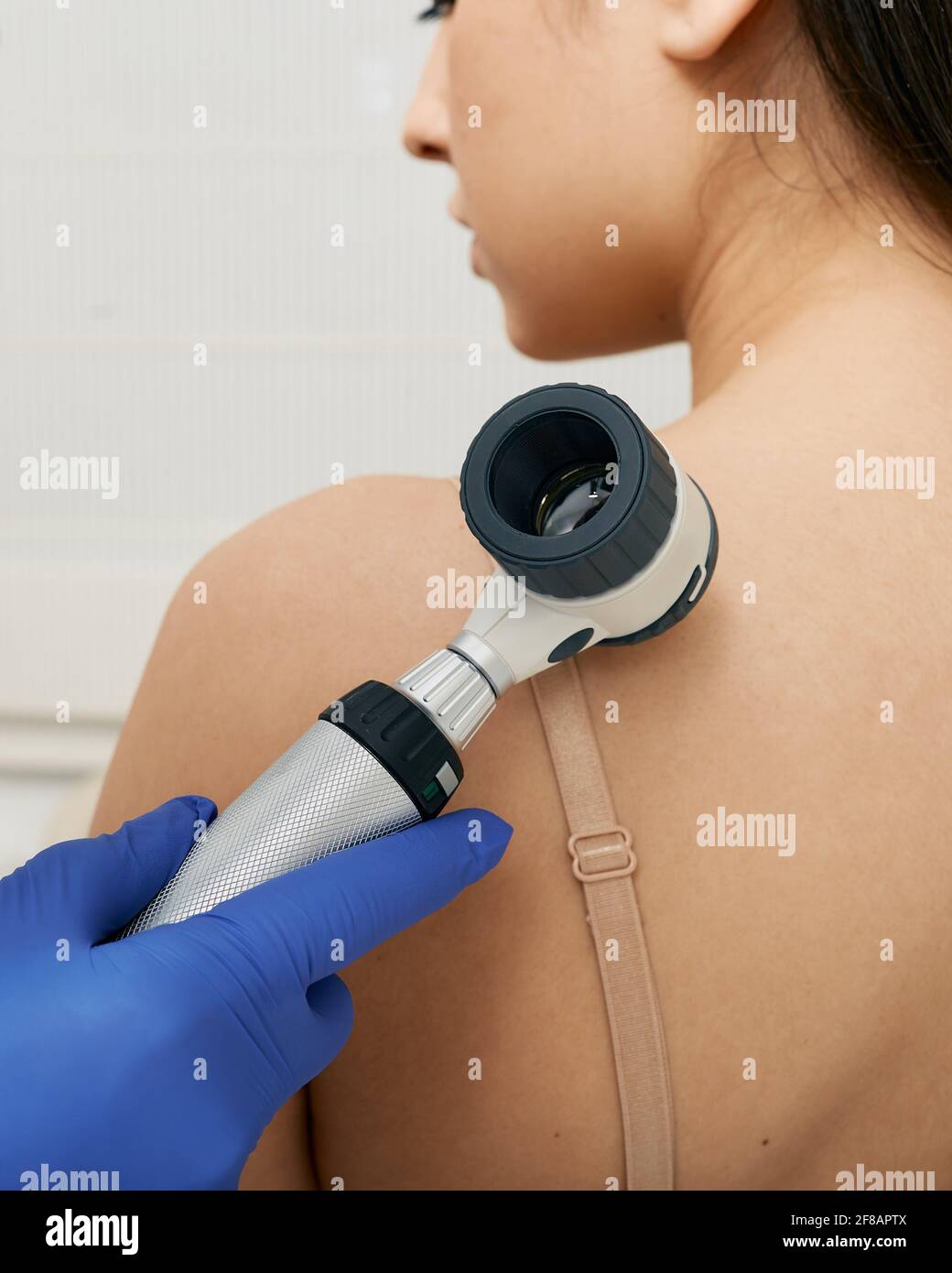 Mole dermoscopy. Physician check-up of a patient's skin with a dermatoscopy for prevention of melanoma and skin cancer, close-up. Stock Photo