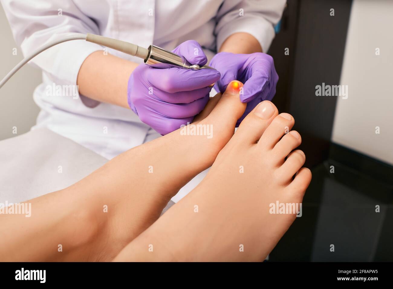 Treatment fungal infection on woman's toenail with podologist using a medical laser. Fungal infection on the human toenails Stock Photo