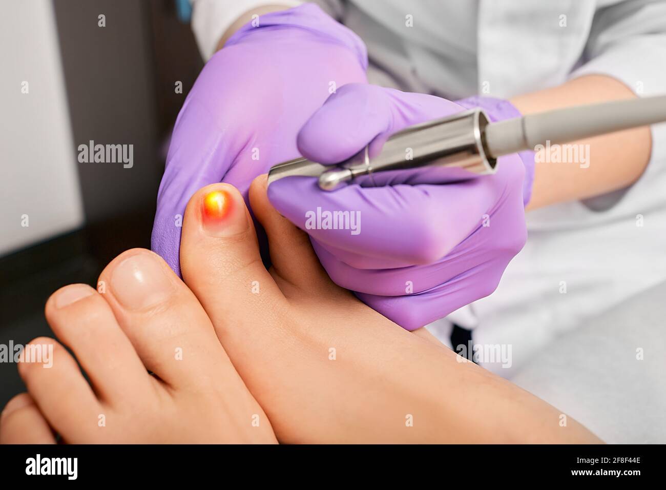 patient having laser treatment fungal infection on toenail, close-up. Onychomycosis treatment with a medical laser at a clinic Stock Photo