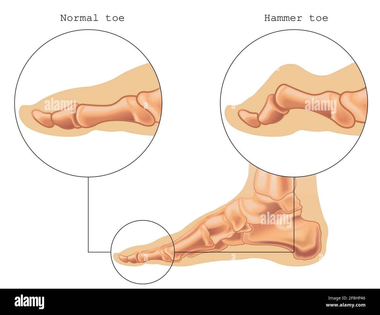 Medical illustration shows the difference between a normal toe and a hammer toe, with annotations. Stock Vector