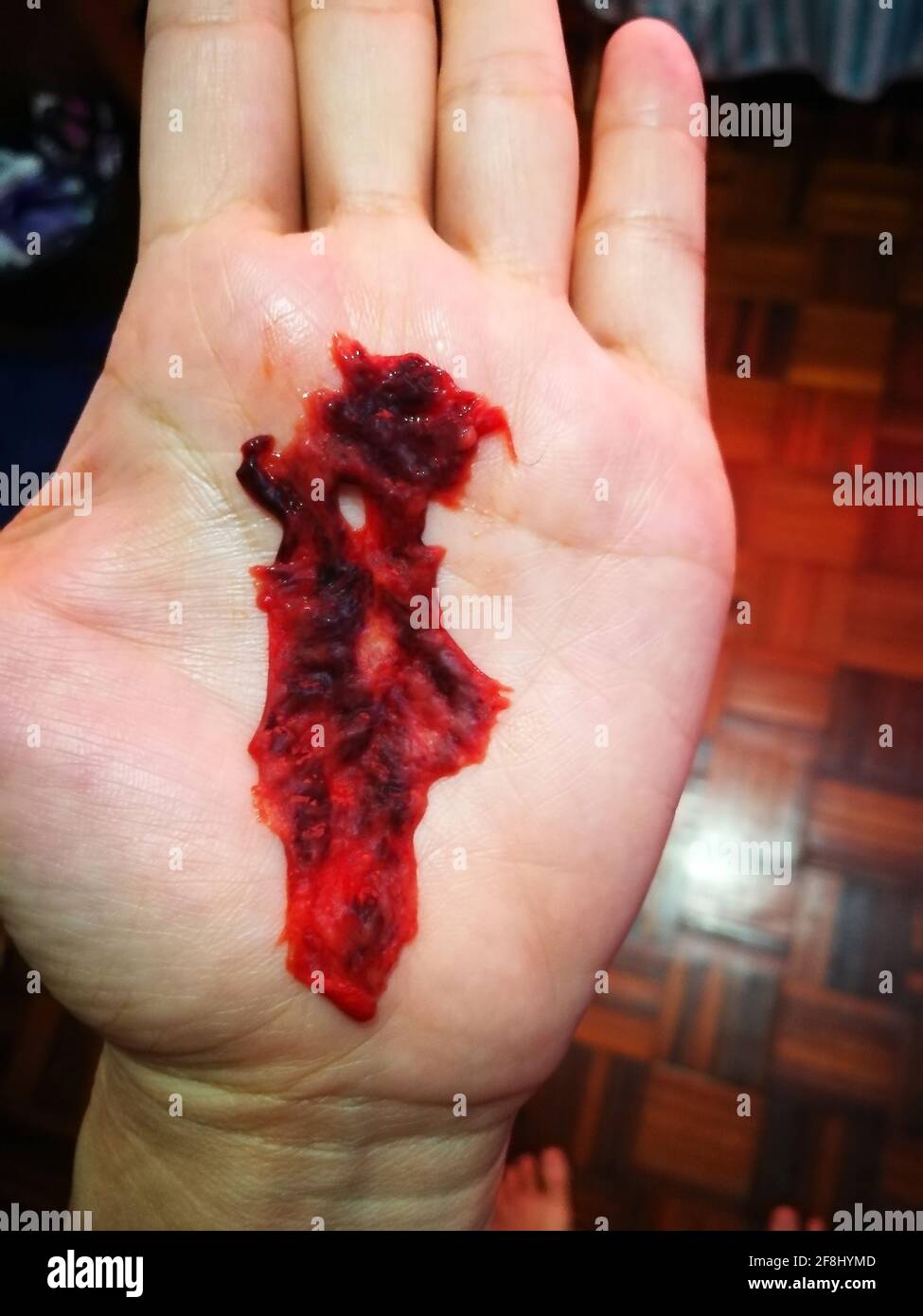 Miscarriage Tissue At 3