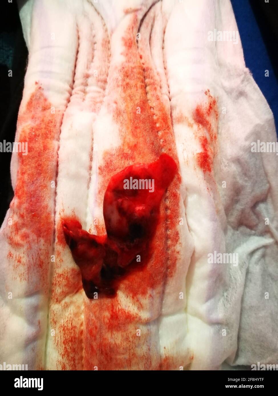 Miscarriage Tissue At 4