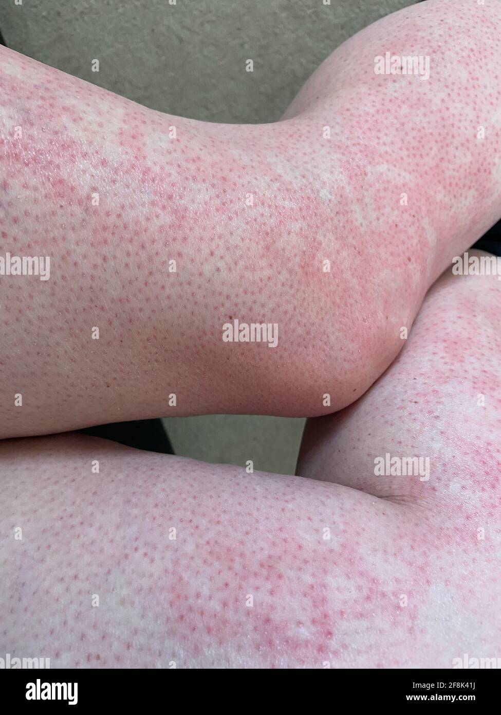 mottled skin heat rash hives allergy reaction on knee close-up reference  picture of blotchy mottled red skin erythema ab igne also known as EAI  Stock Photo - Alamy