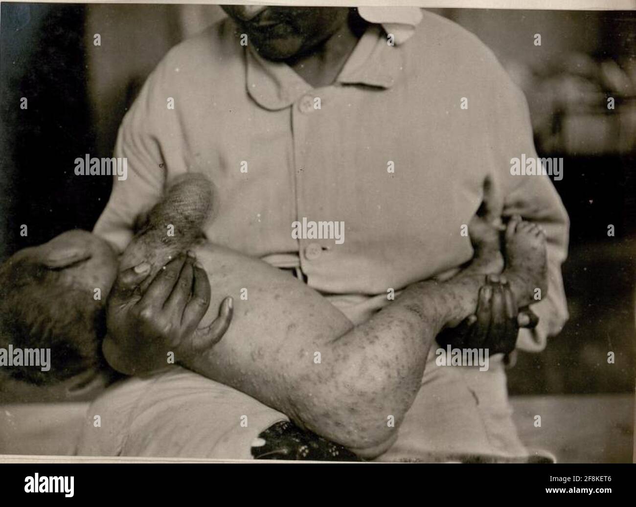 Smallpox variola virus hi-res stock photography and images - Alamy