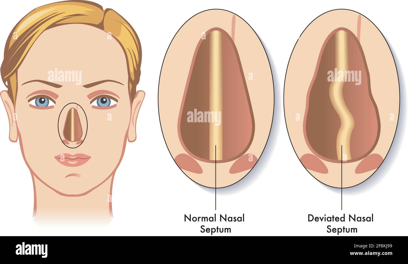 Medical illustration shows the comparison between a normal nasal septum and a deviated nasal septum, with annotations. Stock Vector