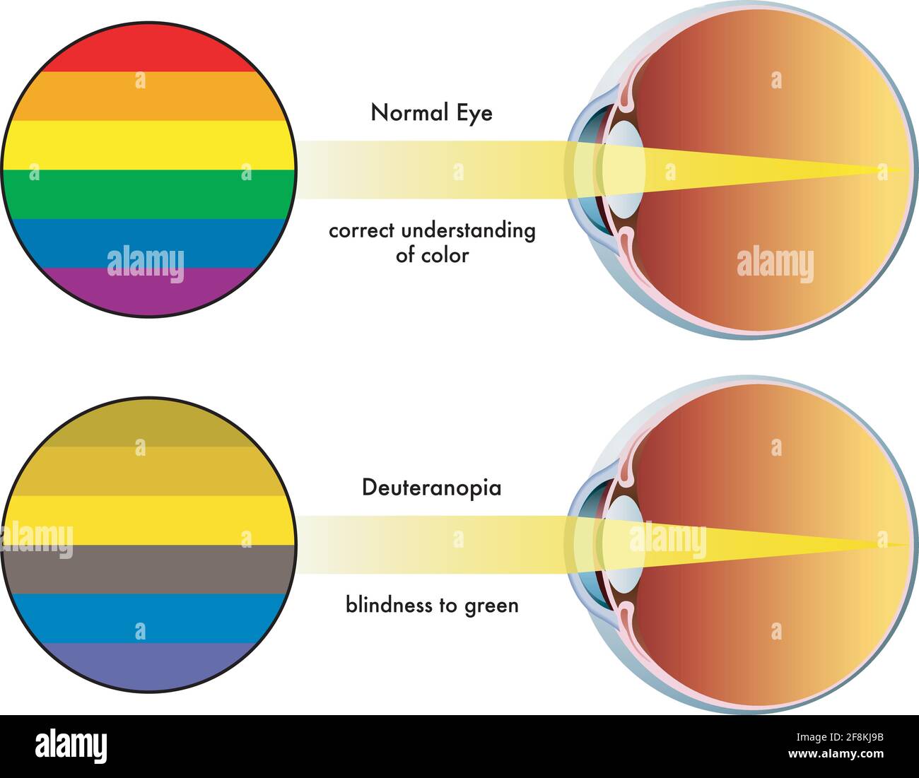 Medical illustration shows how colors are perceived by a healthy eye, and by one affected by deuteranopia. Stock Vector