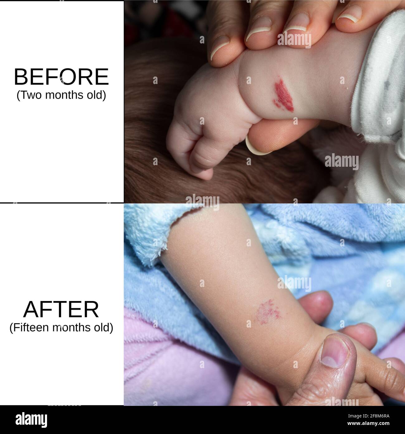 Hemangioma High Resolution Stock Photography And Images Alamy